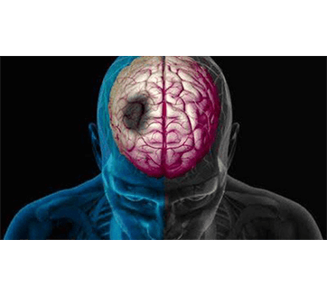 نجات جان ۳۴ بیمار سکته مغزی در کرمانشاه